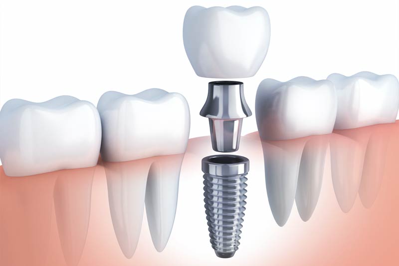 Implants Dentist in Philadelphia